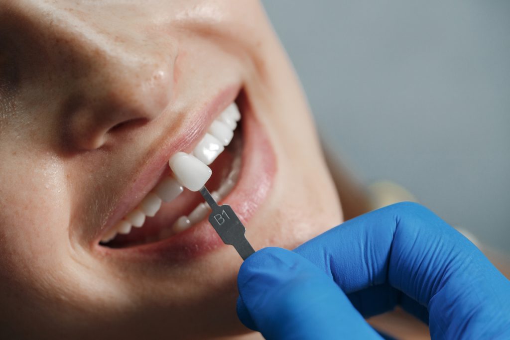 Dental Veneers Carrum Downs